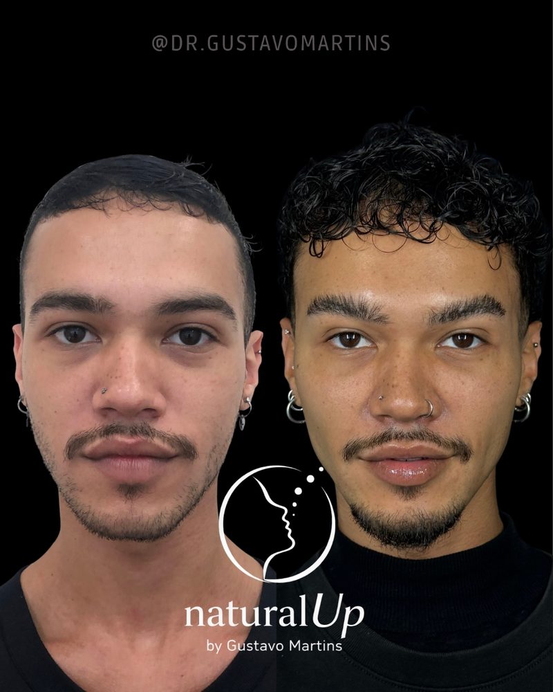 Caso clínico NaturalUp® — antes e depois