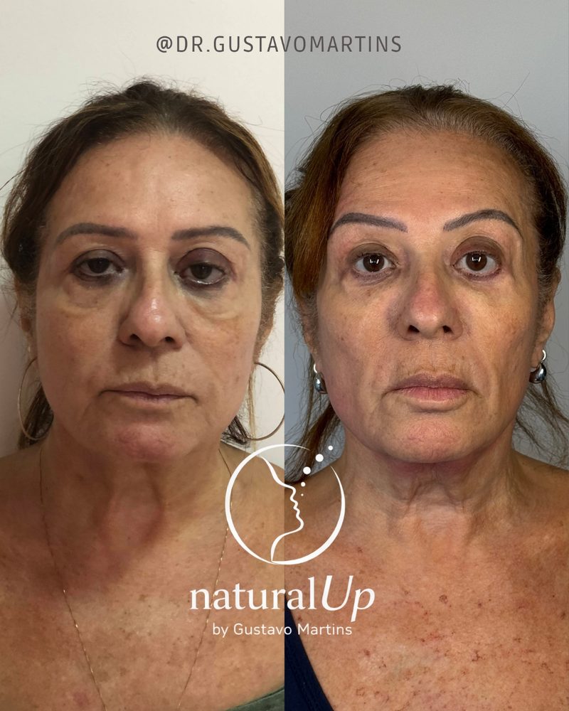 Caso clínico NaturalUp® — antes e depois