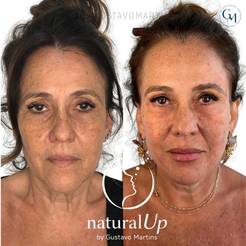 Caso clínico NaturalUp® — antes e depois
