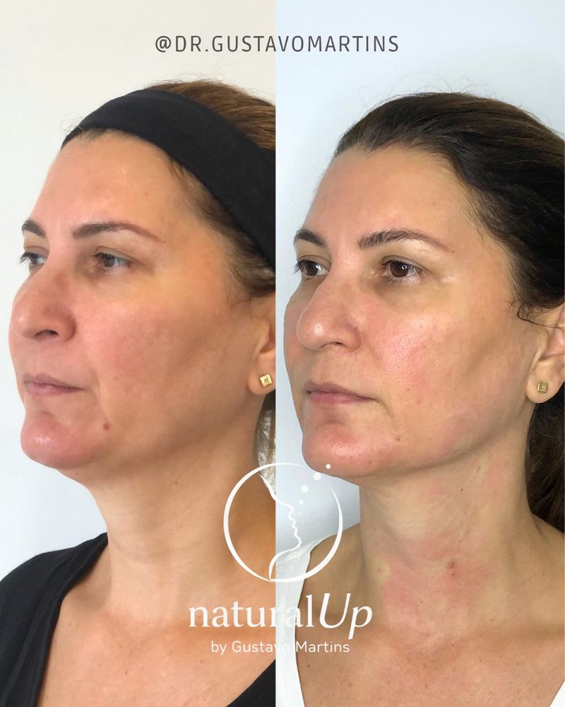 Caso clínico NaturalUp® — antes e depois