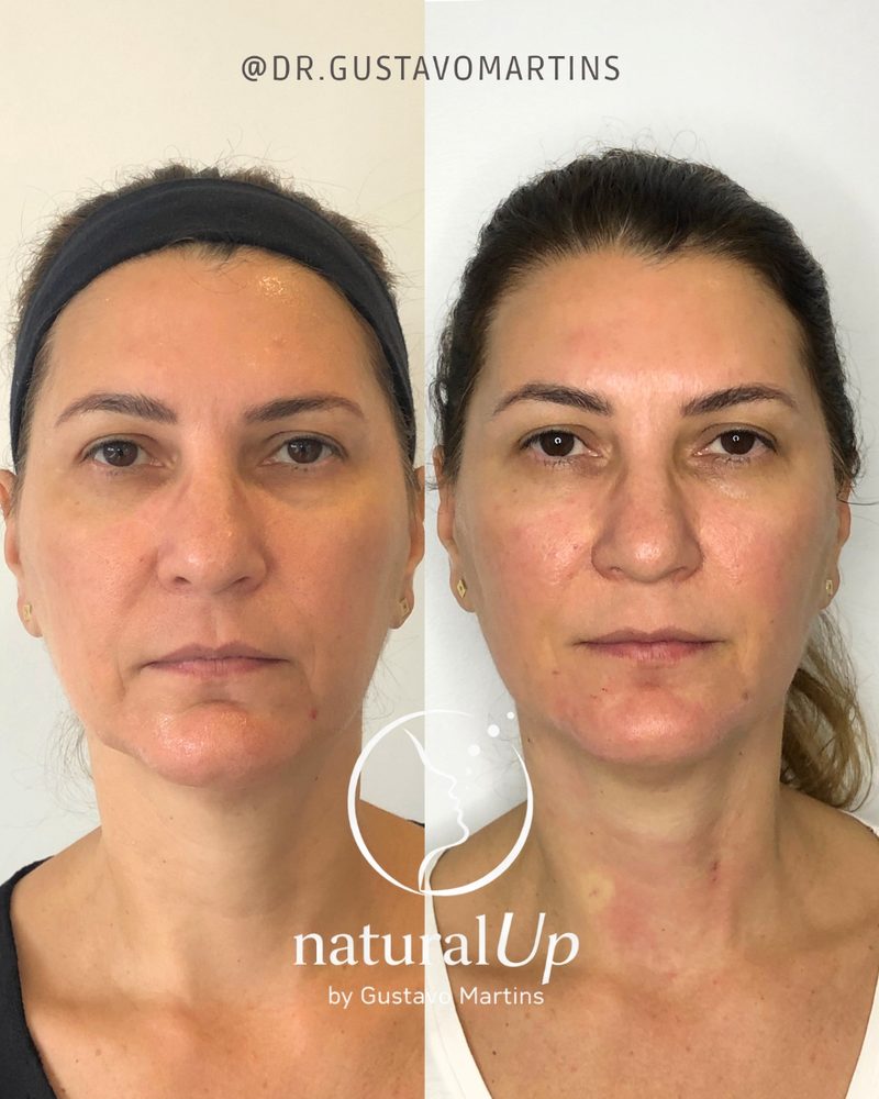 Caso clínico NaturalUp® — antes e depois
