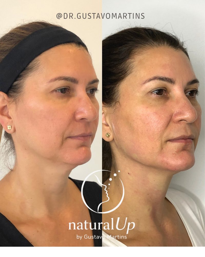 Caso clínico NaturalUp® — antes e depois