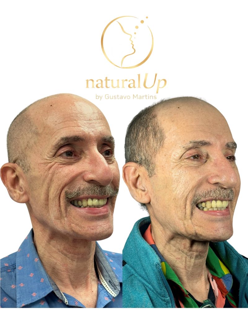 Caso clínico NaturalUp® — antes e depois