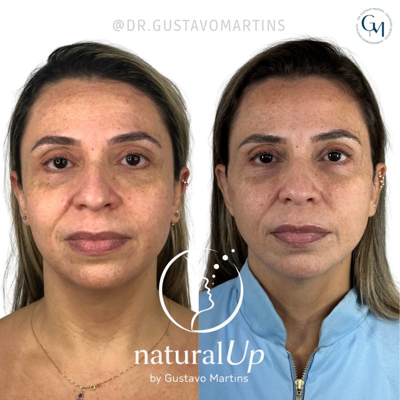 Caso clínico NaturalUp® — antes e depois
