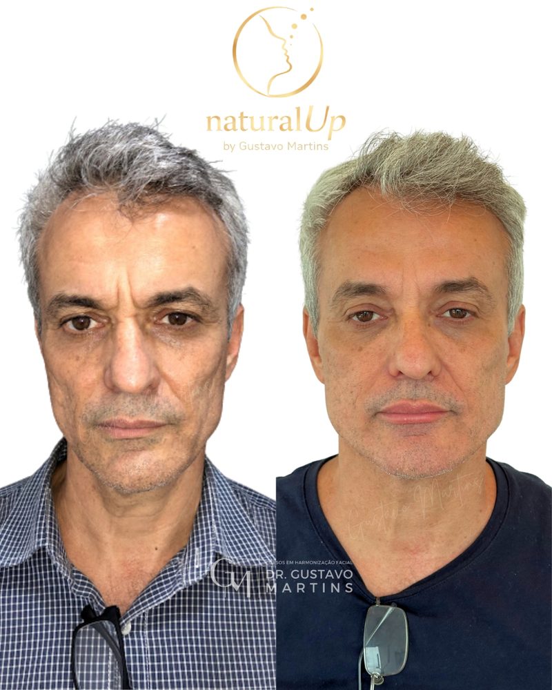 Caso clínico NaturalUp® — antes e depois