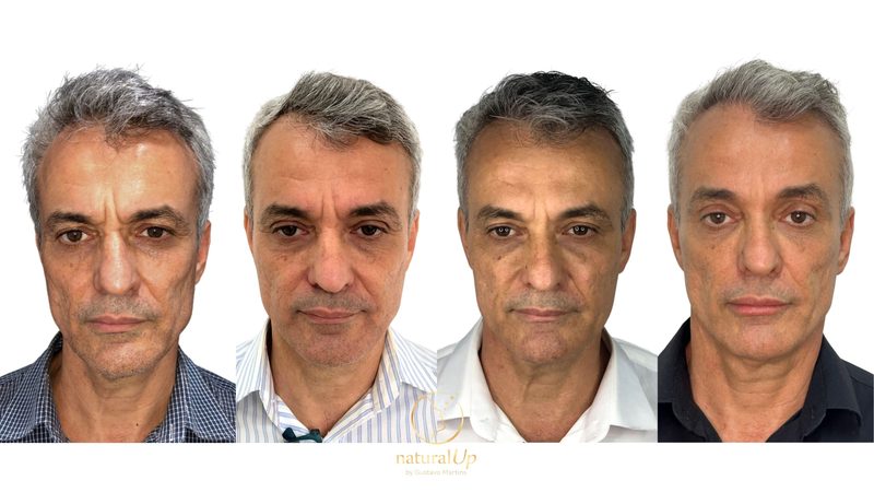 Caso clínico NaturalUp® — evolução completa